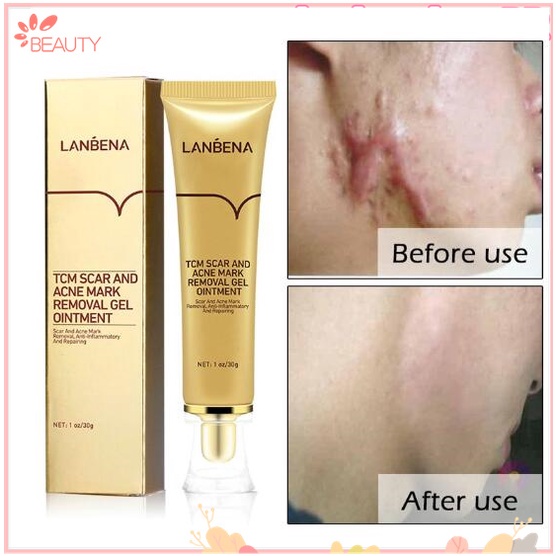 Lanbena Cure Remover Cream Cloves Whitening Marks Scar Remover ZHE
