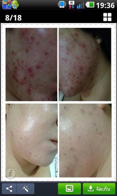 สบู่รักษาสิว หน้าใส ฝ้าจาง แทบไม่ต้องใช้ครีม รูปที่ 3
