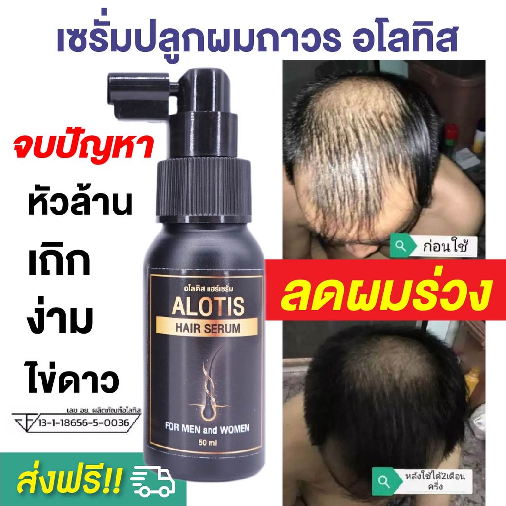เซรั่มปลูกผม Alotis อโลทิส ยาปลูกผม ลดผมร่วง ลดผมบาง หัวล้าน หัวเถิกไข่ดาว รากผมแข็งแรง เห็นผลจริง ม