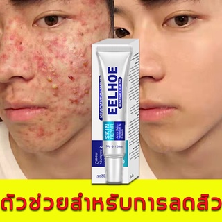 eelhoe ครีมกำจัดสิว 30g ลดเลือนรอยสิว ครีมแต้มสิว ครีมลดสิว ครีมรักษาสิว รักษาสิว เจลรักษาสิว สิวอักเสบ สิวอุดตัน Acne C