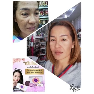 ครีมโยนิเซ่-yonise-cream