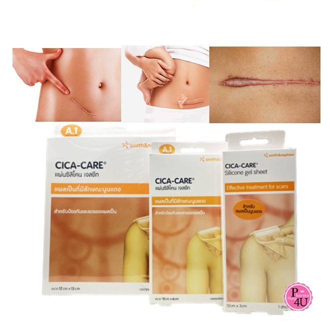 แผ่นซิลิโคน เจลชีท CICA-CARE ลดรอยแผลเป็น cica care Keloid  kelopad
