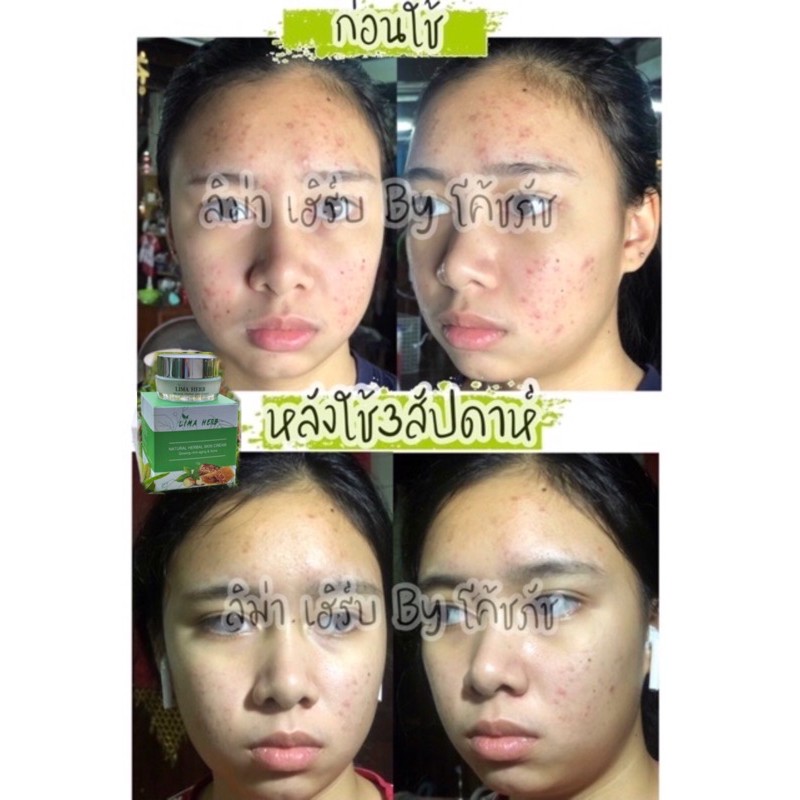 (ขายดี) ครีมลิม่าเฮิร์บ สูตรสลายฝ้า รักษาสิวปรับผิวหน้าให้กระจ่างใสด้วยสารสกัดจากเปลือกมังคุด มะหาด 