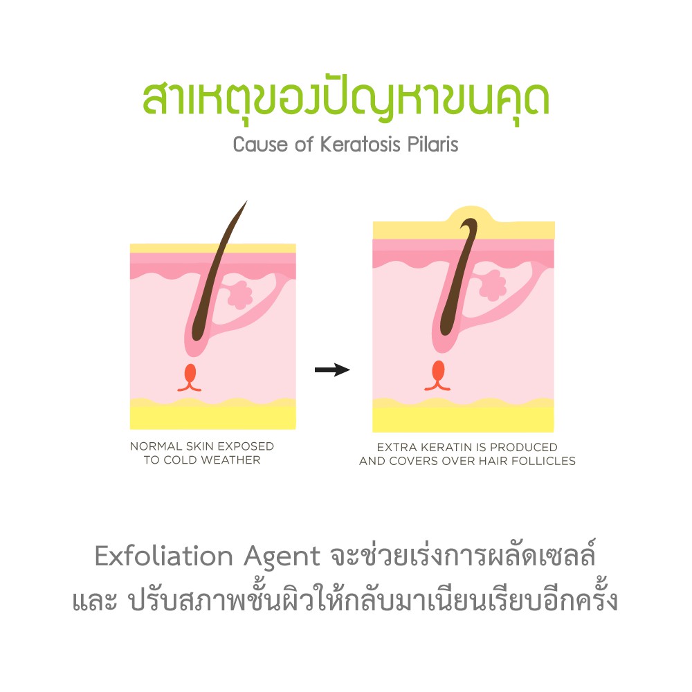Hanedo ชุดเคลียร์ขนคุด ผิวหนังไก่ ปรับผิวให้เรียบเนียน KP Advanced Lotion Plus Rose Extract and Soap set 250ml รูปที่ 2