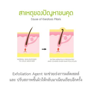 Hanedo ชุดเคลียร์ขนคุด ผิวหนังไก่ ปรับผิวให้เรียบเนียน KP Advanced Lotion Plus Rose Extract and Soap set 450ml