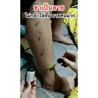 Bioscar ไบโอสการ์เจล ลบรอยแผลเป็น ขาลาย ตุ่ม รอยสิว น้ำเหลืองไม่ดี ผิวแพ้ง่ายใช้ได้ สูตรเข้มข้น สารสกัดจากธรรมชาติ