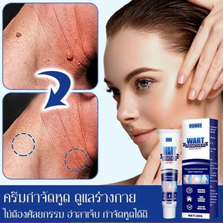 【ซื้อหนึ่งแถมหนึ่ง】ครีมกำจัดหูดซ่อมแซมร่างกาย