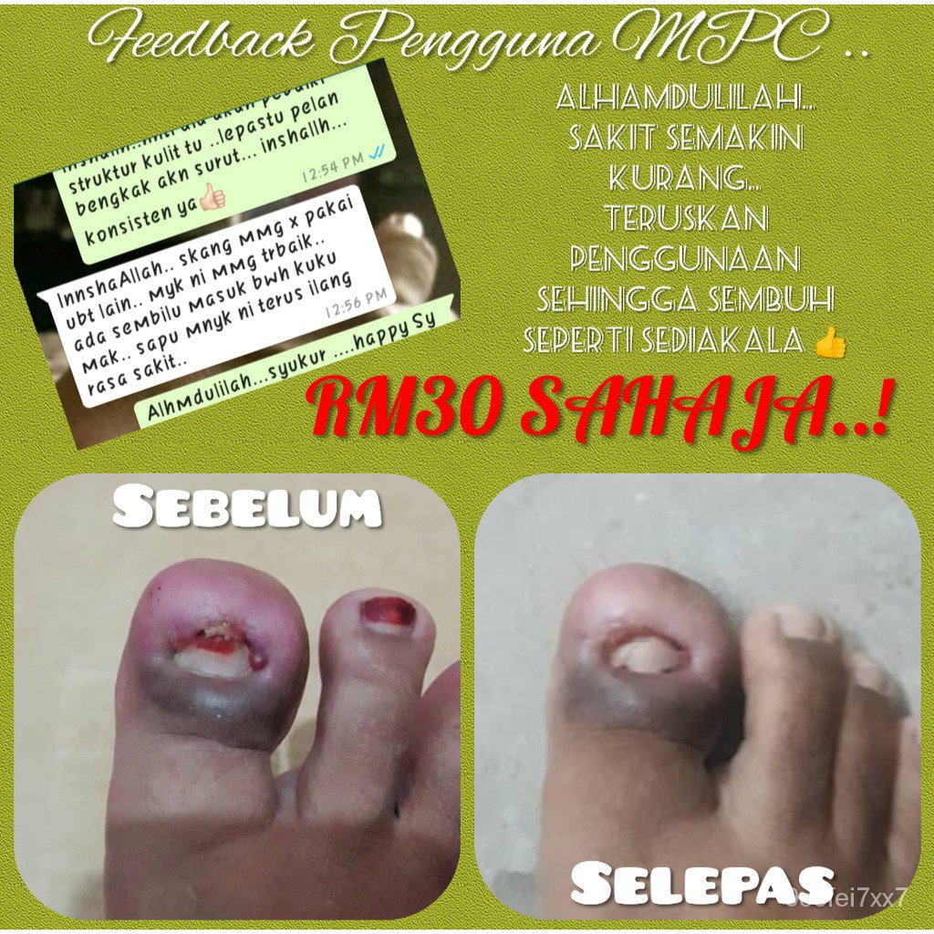 Ubat Kuku Cagu Cengkam Bengkak Bernanah Bisa Berdarah Ingrown Toenail Toe 100 Dari Minyak Kelapa Asli Dan Herba Trpilih Shopee Thailand