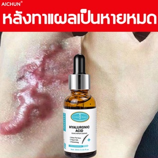 เซรั่มลดรอยแผลเป็นจากสิว Peklat &amp; Keloid Scarminator ครีมรักษารอยแผลเป็นจากสิว รอยแตกลาย