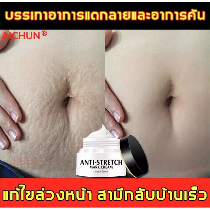 สูตรธรรมชาติ ครีมทาท้องลาย ครีมท้องแตกลาย ครีมทารอยแตกลาย ครีมท้องลาย ของแท้100%Aichun ครีมแก้ท้องลาย ครีมลดรอยแตกลาย