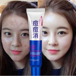 【Horec】ครีมรักษาสิว เจลรักษาสิว Bioaqua Acne cream ไบโออควา ครีมลบสิว ครีมรักษารอยสิว เครื่องสำอางสำหรับผู้ที่เป็นสิว