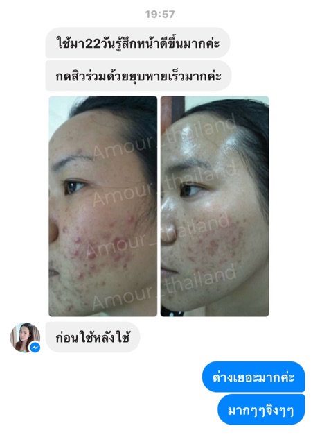 AMOUR Acne Lotion for acne ราคา ถูกที่สุด ดีลบีเคเค แกลเลอรีภาพที่ 4