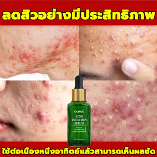 ครีมลดสิว 17ml ที่กดสิว ครีมรักษาสิว ครีมลดสิว ครีมกำจัดสิว เจลแต้มสิว เจลรักษาสิว สิวอุดตัน หลุมสิว ป้องกันสิว ลบรอยแผลเป็นจากสิว เซรั่มรักษาสิว ซ่อมแซมรอยสิว ทำความสะอาดอย่างล้ำลึก ผิวเรียบเนียน ลบรอยสิว กำจัดสิวหัวดำ Acne Essence