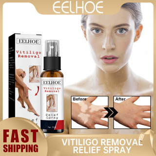 Eelhoe Vitiligo ครีมไวท์เทรทเมนต์ สเปรย์ไวท์แท็ก ทรีทเม้นท์ ครีมรักษาไวติลิโก้ ครีมทาปกปิด