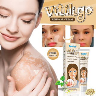 Sumifun vitiligo ทรีทเม้นท์ครีม vitiligo ลบจุดด่างดํา Ubat vitiligo 20 กรัม vitiligo repigment