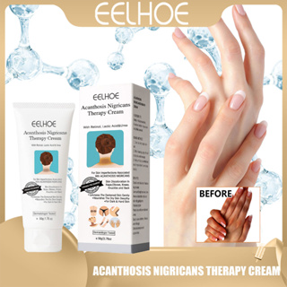 Eelhoe Acanthosis nigricans Therapy Cream ครีมไนไตรไฟซ์ เซรั่มไวท์เทนนิ่ง กําจัดจุดด่างดํา ใต้วงแขน ไวท์เทนนิ่งครีม ให้ความชุ่มชื้น ครีมโลชั่นเพื่อสุขภาพถาวร 50 มล.