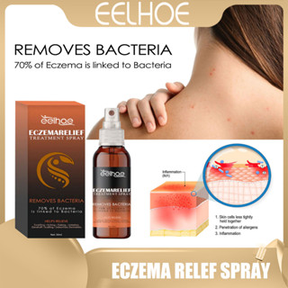 Eelhoe Eczema สเปรย์รักษาโรคสะเก็ดเงิน บรรเทาอาการคัน โรคผิวหนังอักเสบ โรคสะเก็ดเงิน 30 มล.