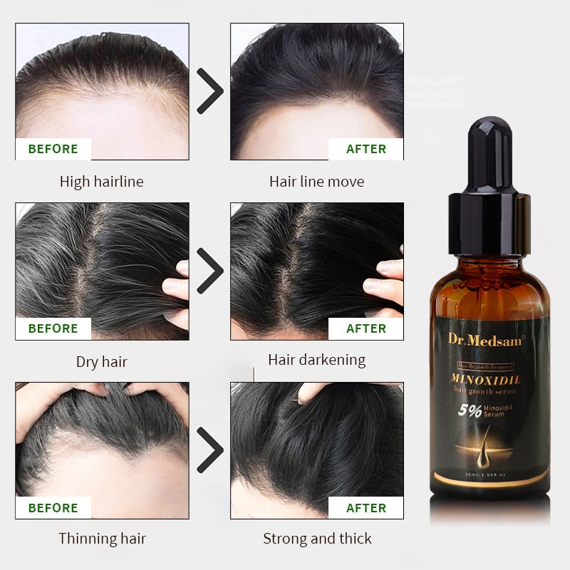 Dr.medsam Hair Regrowth Treatment , 5 % Minoxidil Hair Growth Oil Serum , Anti Hair Loss Treatment , บริสุทธิ ์ 100 % , ใช ้ กับ Derma Roller หรือ Dr.pen