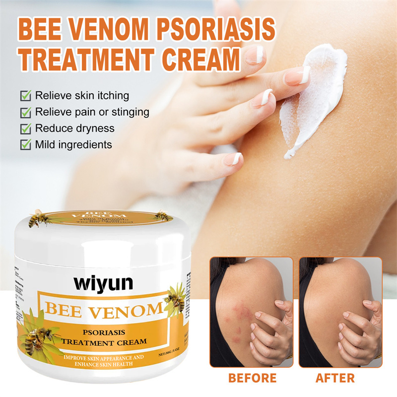 Bee Venom โรคสะเก ็ ดเงินครีมซ ่ อมแซมมือและเท ้ าผิวมอสแดงและอาการคันครีมดูแลผิวให ้ ความชุ ่ มชื ้ นและเรียบเนียน