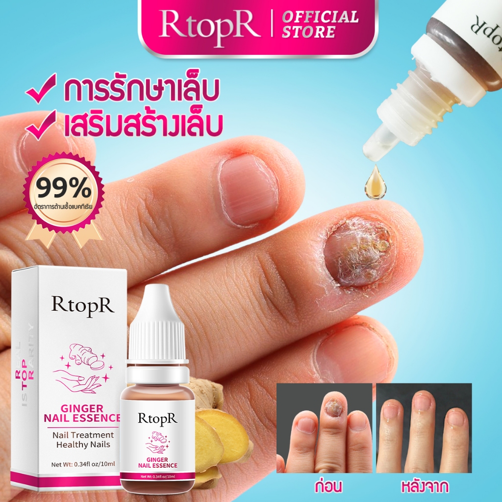 RtopR FDA ยาทาเล็บป้องกันเชื้อแบคทีเรีย รักษาโรคเชื้อราที่เล็บ เล็บพัง ดูแลเล็บ 10 มล.