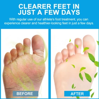 ชา Trea Oil Foot Tinea Pedis Treatment Cream Treat Beriberi Ointment Anti-itch ยับยั้งเชื้อรา Peeling นักกีฬาเท้าครีมทางการแพทย์ 20g