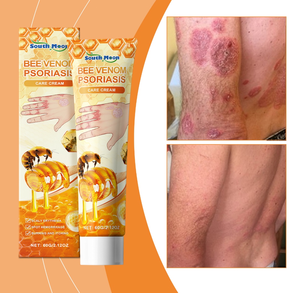 Bee Venom Psoriasis บรรเทา Ointment Urticaria Eczema Treatment ผิวผื่นแดง Alergy Desquamation Antipr