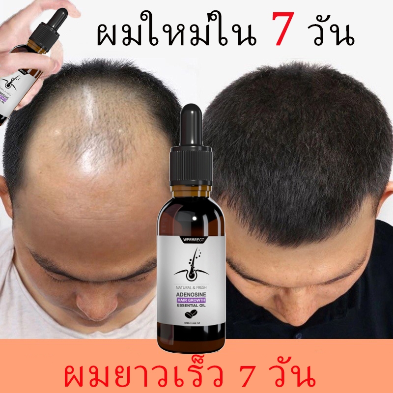 ZKRICARO บอกลาความกังวลเรื่องศีรษะล้าน เซรั่มปลูกผม ป้องกันผมร่วง เร่งผมยาว ฟื้นฟูผม น้ำยาเร่งผมยาว น้ำยาปลูกผม ทรีทเม้นต์ปลูกผม