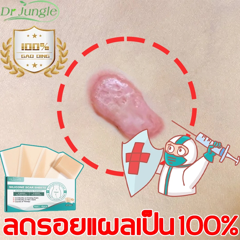 จัดส่งที่รวดเร็ว แผ่นแปะรอยแผลเป็น ลบรอยแผลเป็น 4แผ่น/กล่อง ลบรอยแผลเป็นแผลผ่าตัด เผยผิวเนียนสวย