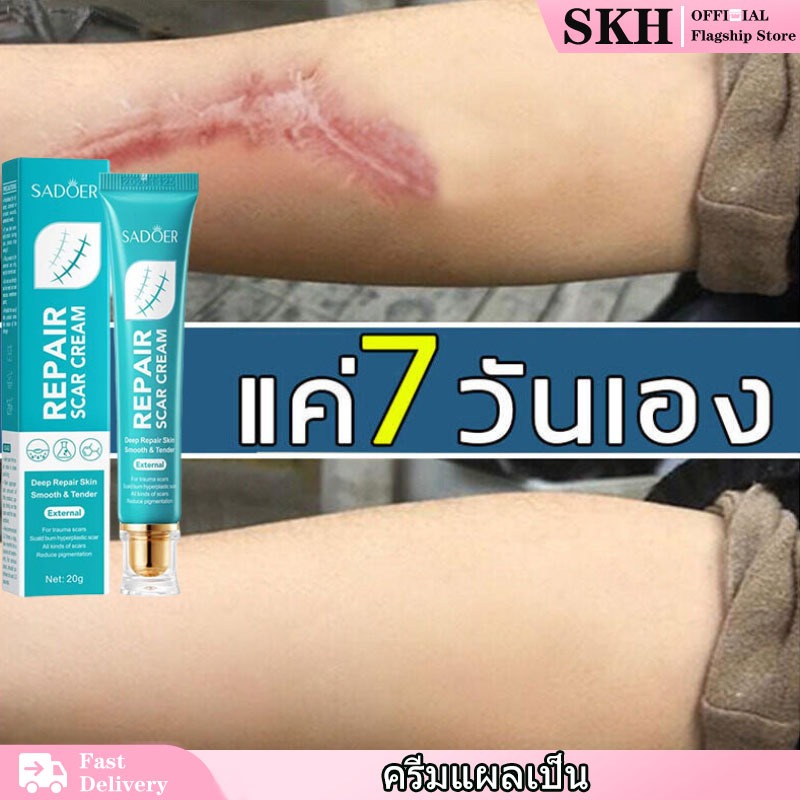 รอยแผลเป็น ครีมแผลเป็น 20g ทาแผลคีลอยด์ ลดแผลเป็น ครีมทาแผลผ่าคลอด ลดแผลไฟไหม้ รอยสิว แผลผ่าตัดเป็นต้น Scar cream