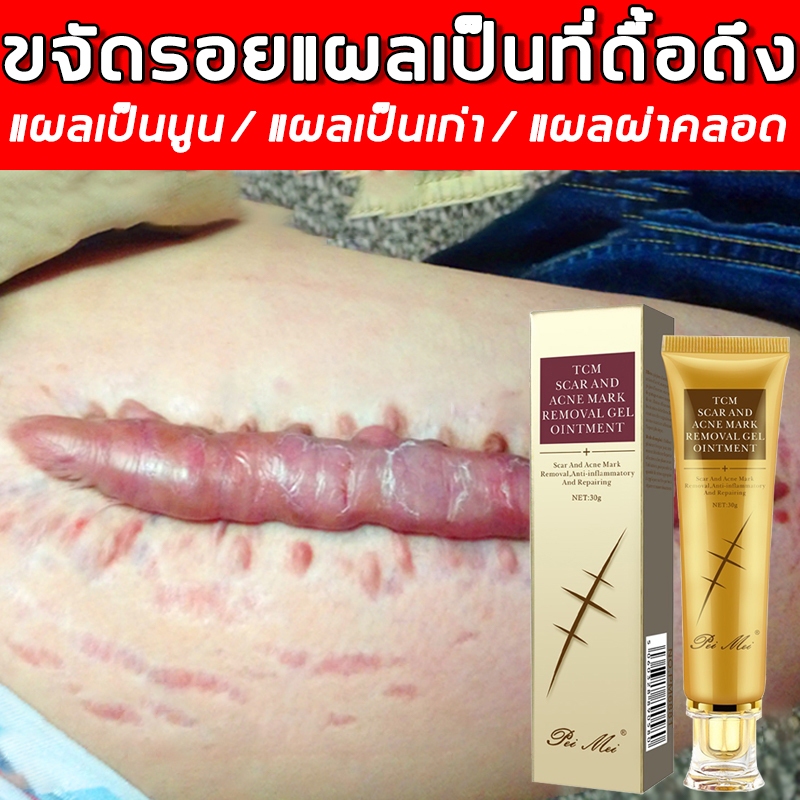 ครีมเจลยาจีนแท้ ลบรอยแผลเป็น รอยสิว รอยบาดเจ็บ ฟื้นฟูผิวอย่างเห็นผล