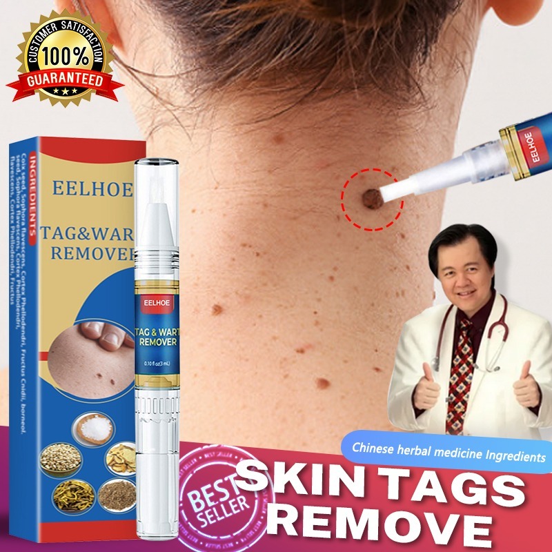 Original Warts Remover Watson Warts Removal Mole และ Warts Remover Skin Tags และ Warts Remover Wartz