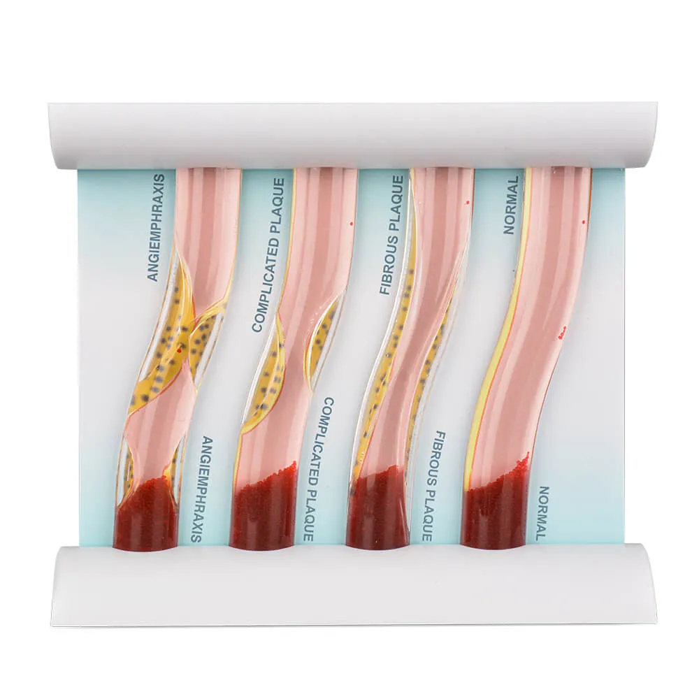 โมเดล Blockage Blood Vessel - เครื่องมือจําลองภาวะไขมันสูง