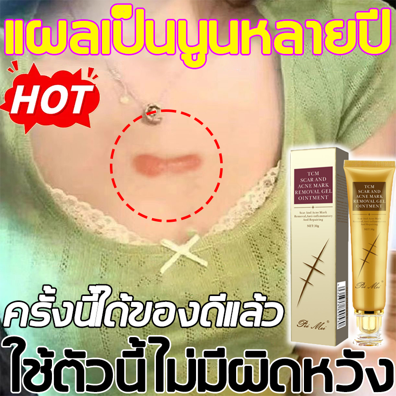 เห็นผลรวดเร็ว 🚀 ครีมลดรอยแผลเป็น Peimei ขนาด 30 กรัม ลดรอยแผลเป็น ลดรอยสิว ฟื้นฟูรอยแผลจากการผ่าตัดคลอด รอยแผลไฟไหม้ รอยนูน รอยตัด และรอยแผลจากการผ่าตัด