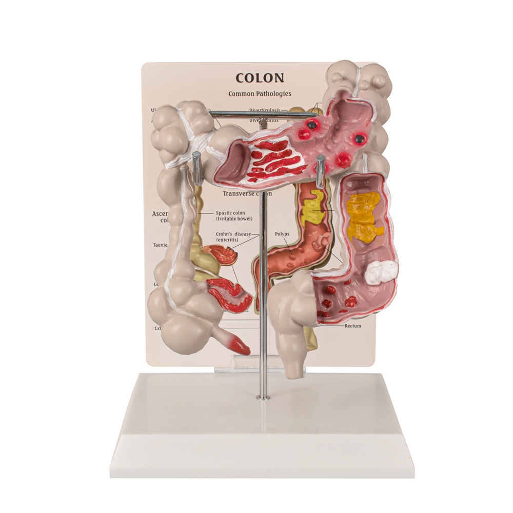 โมเดลโรคทั่วไป Colon & Rectum ระดับพรีเมียมสําหรับการศึกษากายวิภาคศาสตร์