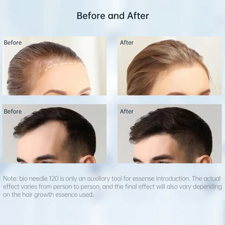 Bi0 เข็ม 120 Derma แสตมป์ปรับความยาว Microneedleing สําหรับ Face Body Care ใช้ในบ้าน