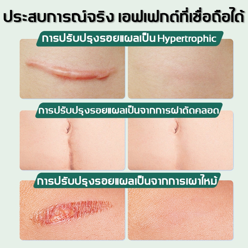 🔥ของแท้🔥Drjungle แผ่นแปะลดรอยแผลเป็น แผ่นแปะซิลิโคน ลดรอยแผลเป็นใหม่และเก่า ลดรอยแผลนูน แผลเป็น และแผลจากการตัดผ่าตัด ฟื้นฟูผิวส้ม และเส้นการเจริญเติบโตของผิวให้เรียบเนียน ขนาด 4*7.5cm
