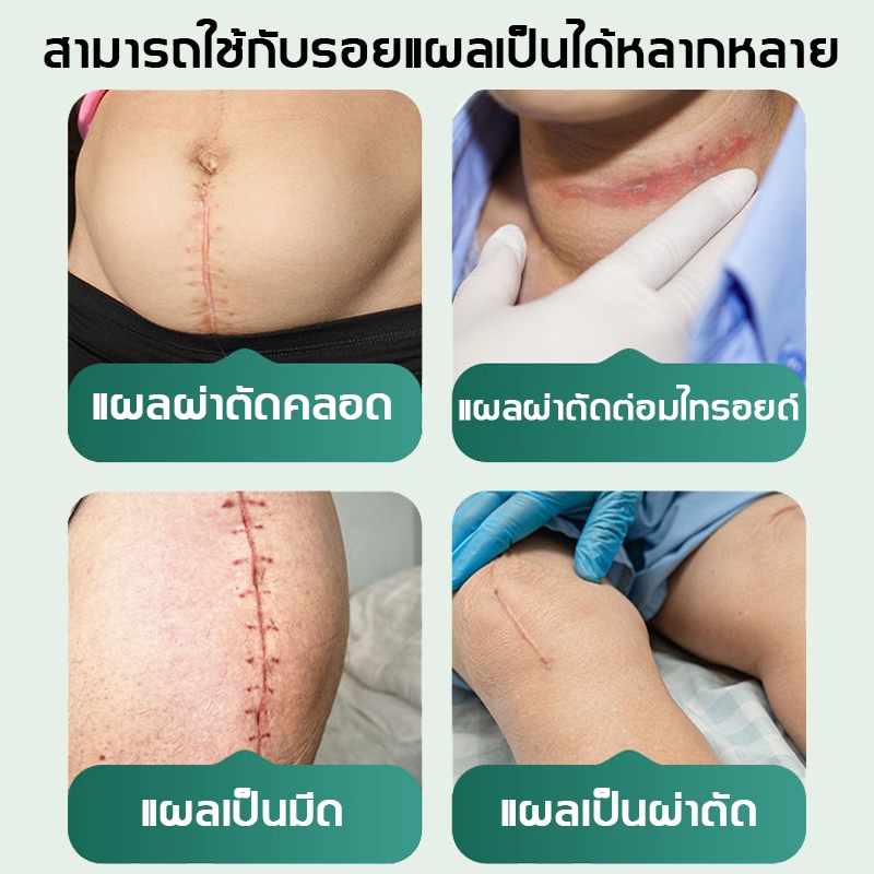 🔥ของแท้🔥Drjungle แผ่นแปะลดรอยแผลเป็น แผ่นแปะซิลิโคน ลดรอยแผลเป็นใหม่และเก่า ลดรอยแผลนูน แผลเป็น และแผลจากการตัดผ่าตัด ฟื้นฟูผิวส้ม และเส้นการเจริญเติบโตของผิวให้เรียบเนียน ขนาด 4*7.5cm