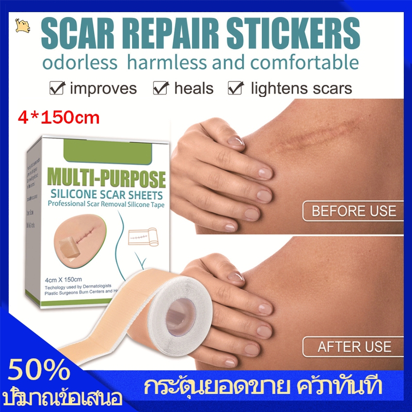 【จัดส่งในพื้นที่】 ซิลิโคนเจลแถบแพทช์ซิลิโคนแผลเป็นแผ่นนํามาใช้ใหม่ซิลิโคนแผลเป็นกําจัดแพทช์ลบ ทราอูมา เผาแผ่นผิวซ่อมแซมรอยแผลเป็นกําจัดเชื