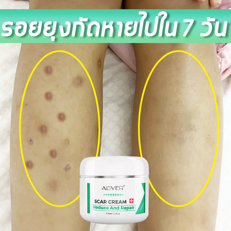 💖ของแท้🚀ALIVER ครีมลดรอยแผลเป็น ลดรอยดำจากยุงกัด  แผลเป็นนูน แผลเป็นบริเวณต่อมไทรอยด์ รอยแผลเป็น 50ml
