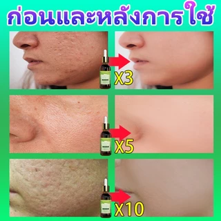 ✈️นำเข้าจากเกาหลี✈️ เซรั่มกระชับรูขุมขน รูขุมขน​​กระชับแก่นแท้ ลดรอยสิว การกำจัดสิวหัวดำ ลดริ้วรอย ผิวชุ่มชื้น ซ่อมแซมน้ํามัน ควบคุมความมัน กระชับรูขุมขน ผิว เหมาะสําหรับผิวแพ้ง่าย