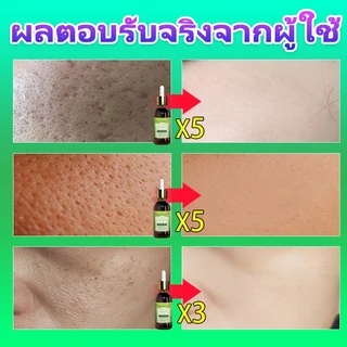 ✈️นำเข้าจากเกาหลี✈️ เซรั่มกระชับรูขุมขน รูขุมขน​​กระชับแก่นแท้ ลดรอยสิว การกำจัดสิวหัวดำ ลดริ้วรอย ผิวชุ่มชื้น ซ่อมแซมน้ํามัน ควบคุมความมัน กระชับรูขุมขน ผิว เหมาะสําหรับผิวแพ้ง่าย