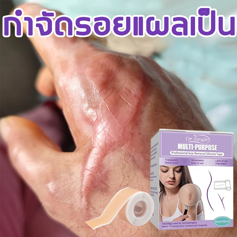 🔥100% ของแท้🔥 Dr.Jungle แผ่นแปะแผลเป็น แผ่นแปะคีลอยด์ แผ่นแปะซิลิโคน 4*150cm (กำจัดแผลเป็นอย่างรวดเร็ว แผ่นแปะลดรอยแผลเป็น แผ่นแปะซิลิโคนเจล แผ่นแปะรอยแผลเป็นนูน ครีมลบรอยแผลเป็น)