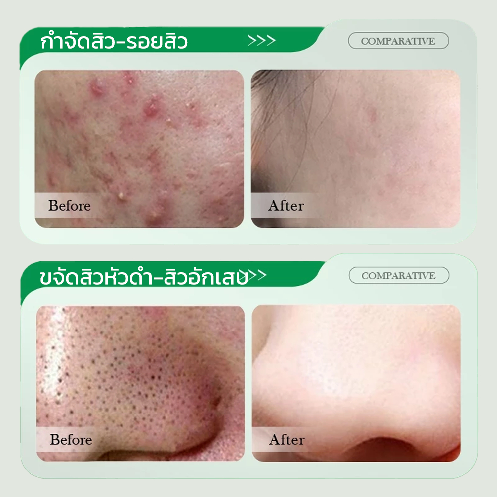 3% Salicylic Acid Acne Face Cream Oil Control Skin Barrier Repair 50g - รูปที่ 7
