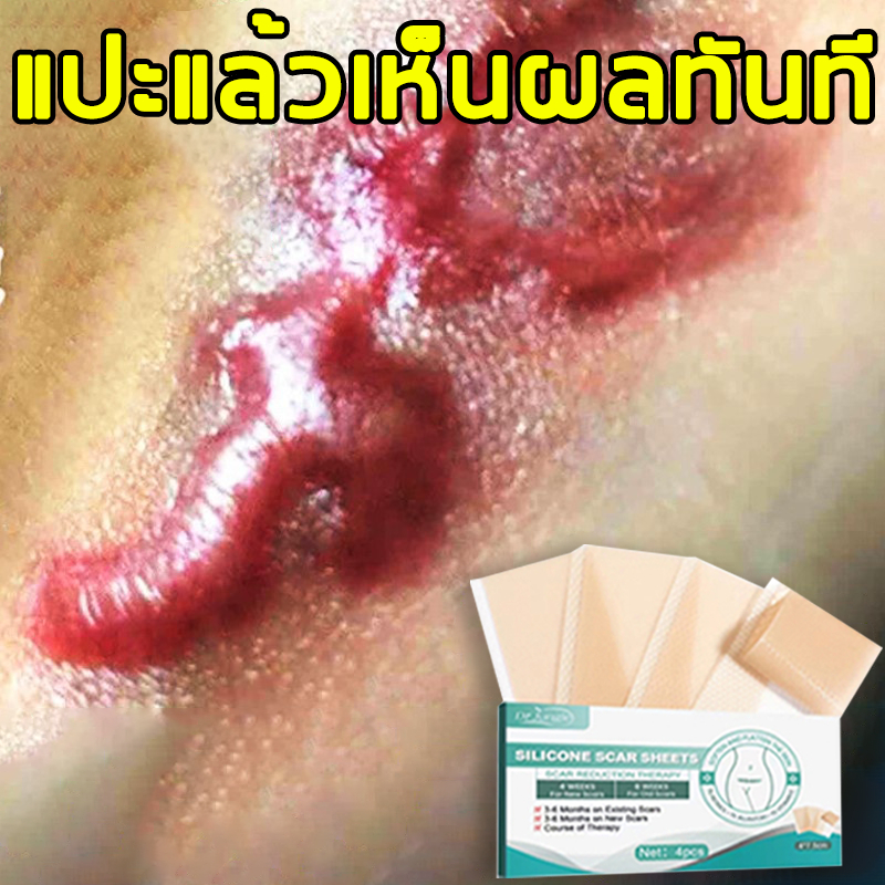 🔥ของแท้🔥Drjungle แผ่นแปะลดรอยแผลเป็น แผ่นแปะซิลิโคน ลดรอยแผลเป็นใหม่และเก่า ลดรอยแผลนูน แผลเป็น และแผลจากการตัดผ่าตัด ฟื้นฟูผิวส้ม และเส้นการเจริญเติบโตของผิวให้เรียบเนียน ขนาด 4*7.5cm