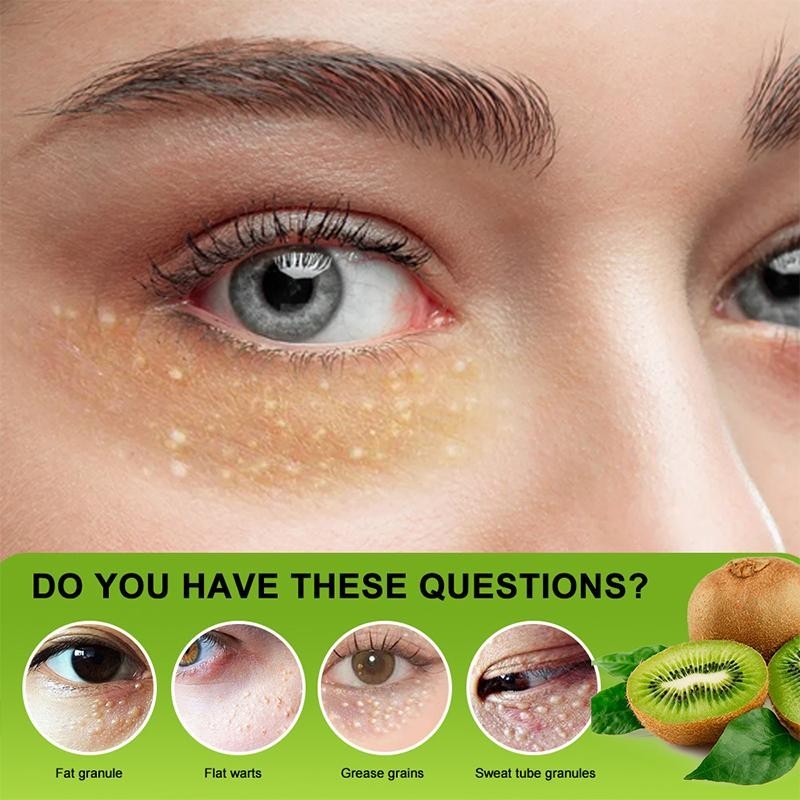วิตามินอี Krim Milia Seed Remover Eye Cream Fat Granule Syringoma Milia Remover Grease Grains Eye Ca