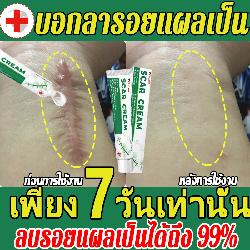 ครีมเจลรักษาแผลเป็น ลดรอยแผลเป็นจากสิว ฟื้นฟูปิดแผลผ่าตัด ยกผิวเนียน