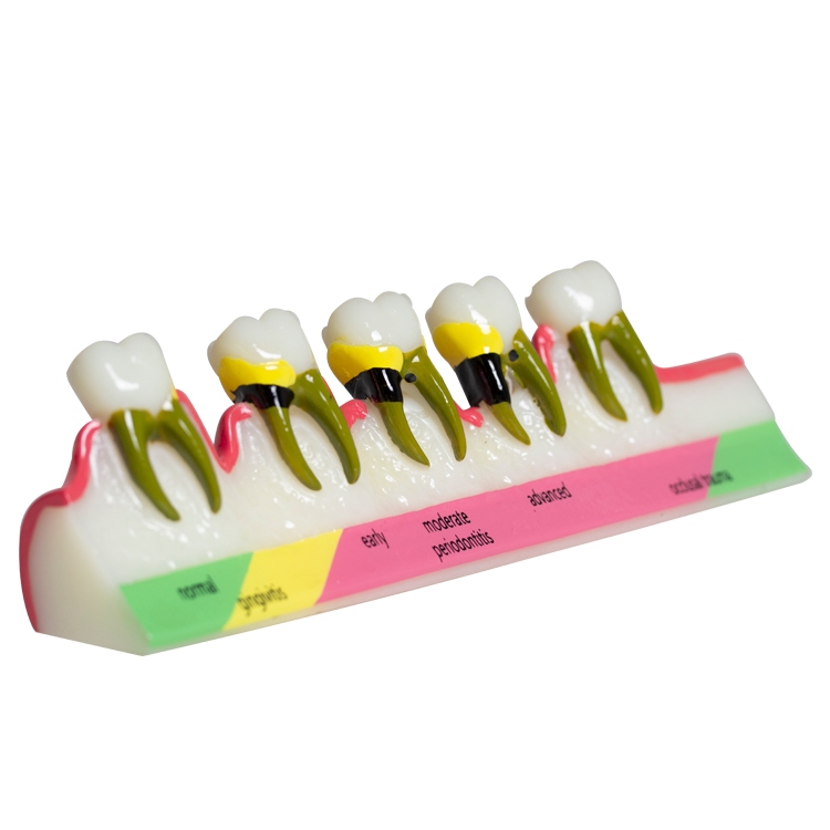 โมเดลฟัน รุ่น Caries Evolution 5 Stage Demo สําหรับทันตกรรม
