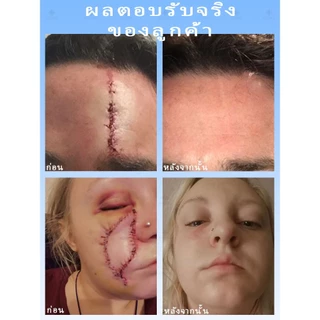 [กำจัดรอยแผลเป็น] ครีมลบรอยแผลเป็นอย่างรวดเร็ว เหมาะสำหรับการซ่อมแซมผิวจากรอยแผลเป็นจากการเสียดสี จากไฟไหม้ หลังผ่าตัด แตกลาย ฯลฯ