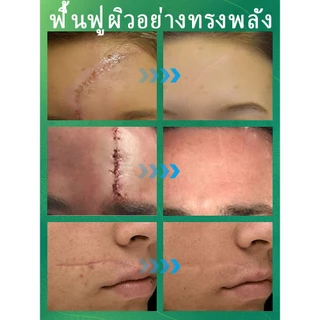 [กำจัดรอยแผลเป็น] ครีมลบรอยแผลเป็นอย่างรวดเร็ว เหมาะสำหรับการซ่อมแซมผิวจากรอยแผลเป็นจากการเสียดสี จากไฟไหม้ หลังผ่าตัด แตกลาย ฯลฯ