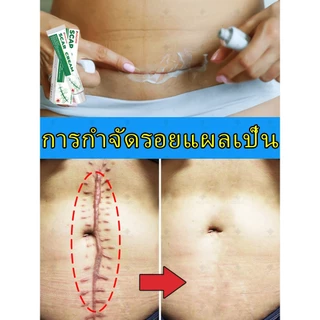 [กำจัดรอยแผลเป็น] ครีมลบรอยแผลเป็นอย่างรวดเร็ว เหมาะสำหรับการซ่อมแซมผิวจากรอยแผลเป็นจากการเสียดสี จากไฟไหม้ หลังผ่าตัด แตกลาย ฯลฯ